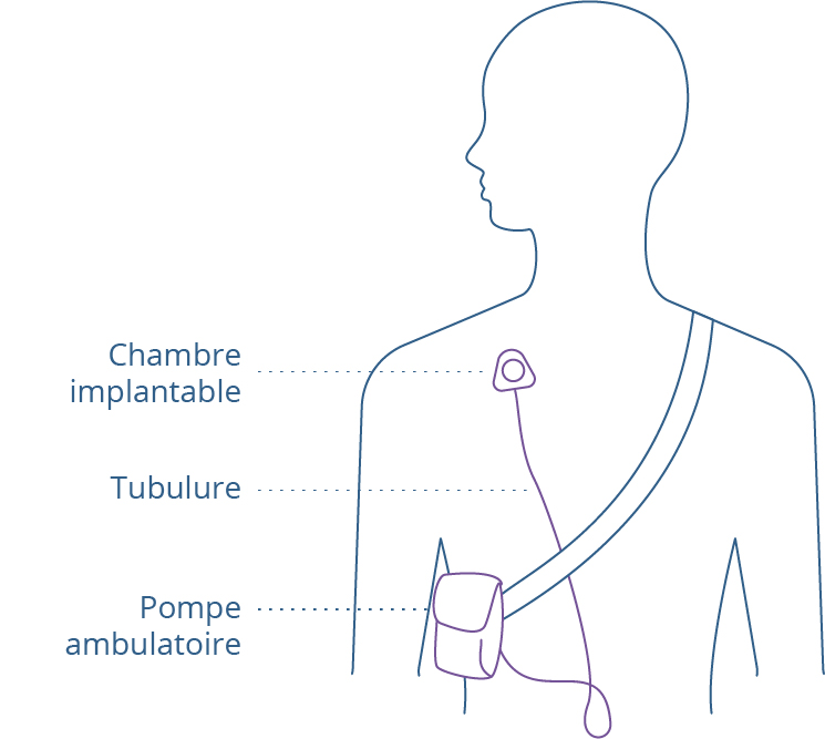 Schéma explicatif de la chimiothérapie avec la chambre implantable et la tubulure qui est relie la chambre avec la pompe ambulatoire.