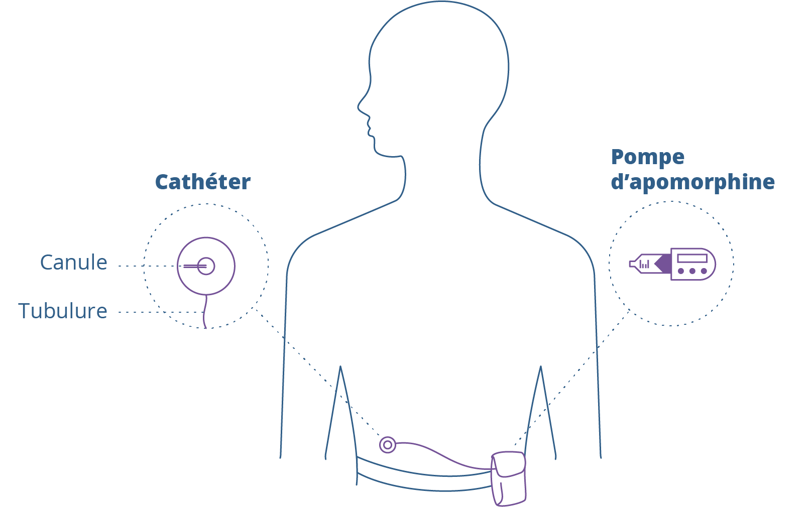 pompe d'apomorphine avec cathéter
